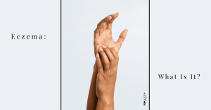 Eczema: What Is It?